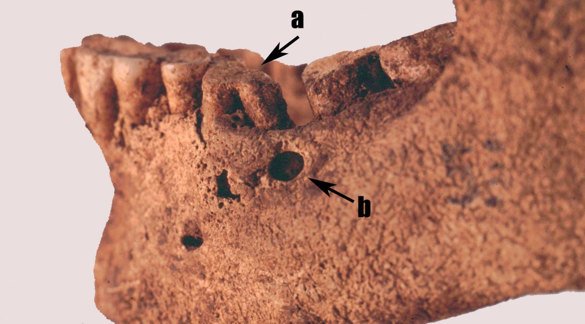 Veduta laterale della mandibola di Romito 8.  Primo molare sinistro con corona usurata (a), fistola di un ascesso periapicale (b)