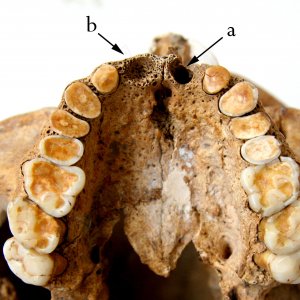 L'eccezionale usura delle superfici occlusali dei denti usati per la lavorazione di pellame o di altro materiale semiduro
